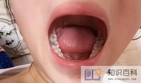 拍片有智齿一定会长吗2