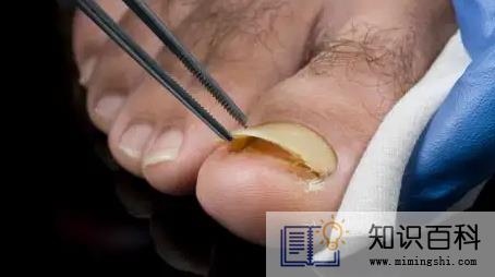 怎么判断是空甲还是灰指甲2