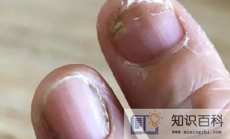 怎么判断是空甲还是灰指甲3
