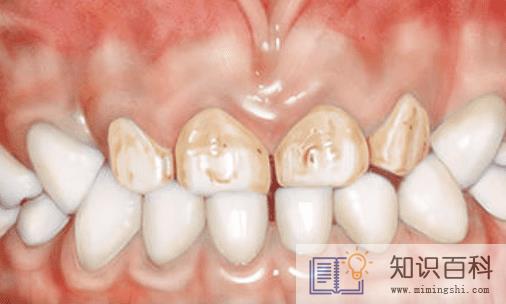 牙釉质脱落一点点要紧吗3