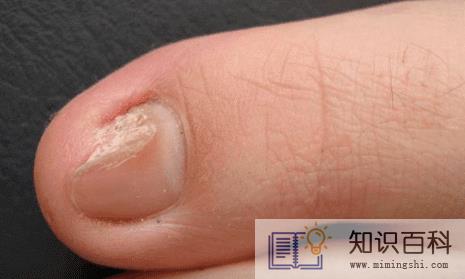 为什么15岁的女孩会有灰指甲1