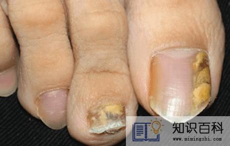 为什么15岁的女孩会有灰指甲2