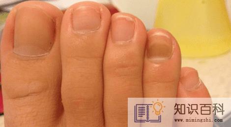 如何鉴别灰指甲严重程度1