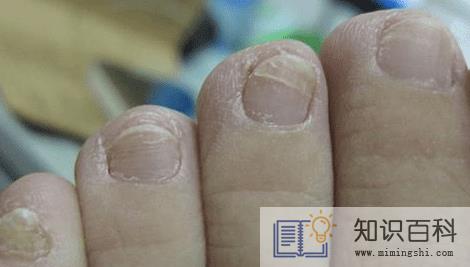如何鉴别灰指甲严重程度2