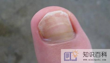 如何鉴别灰指甲严重程度3
