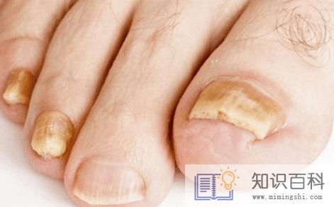 灰指甲初期样子图片轻微1