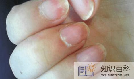 灰指甲初期样子图片轻微2