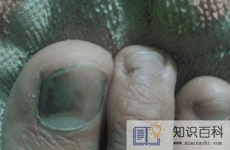灰指甲初期样子图片轻微3