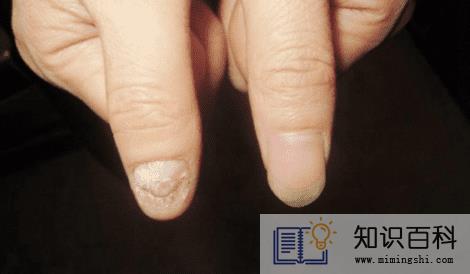 灰指甲初期样子图片轻微4