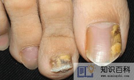 灰指甲初期样子图片轻微5