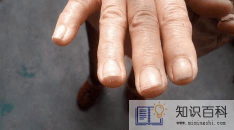 怎样识别灰指甲1
