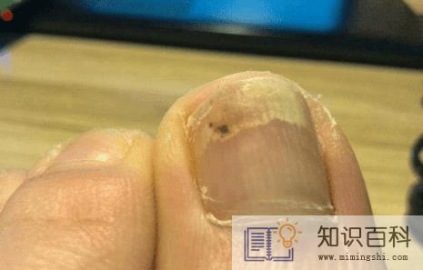 怎样识别灰指甲2