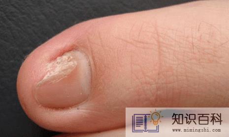 怎样识别灰指甲3
