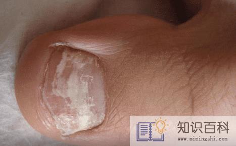 怎样识别灰指甲4