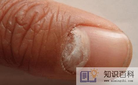 怎样识别灰指甲5