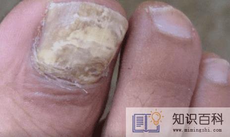 怎样识别灰指甲6
