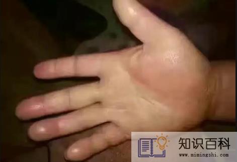 手脱皮是什么原因导致的4