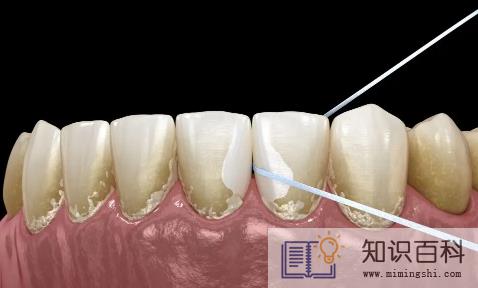 抠牙结石工具叫什么2