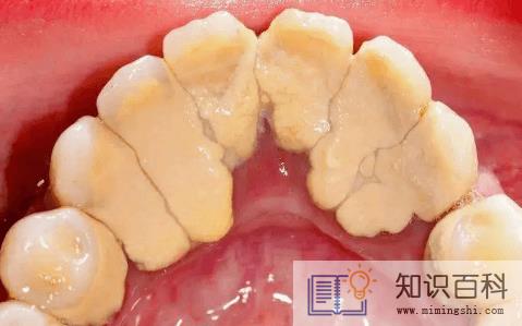 牙结石自然脱落正常吗1
