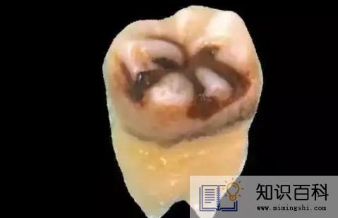 牙结石自然脱落正常吗2