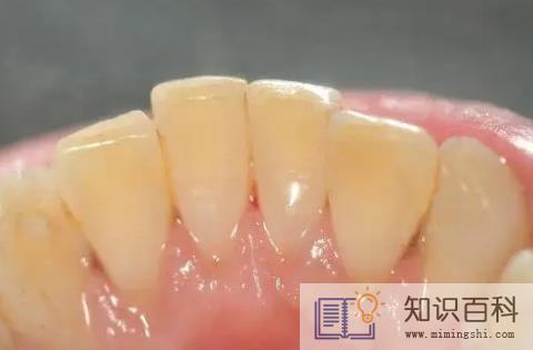 牙结石自然脱落正常吗3