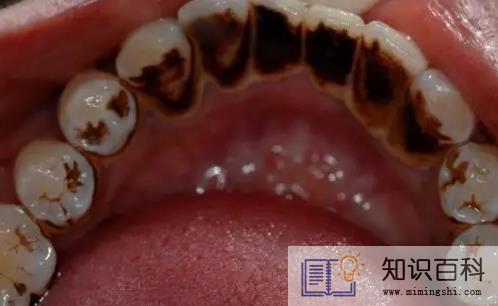 牙结石0度到3度的图1