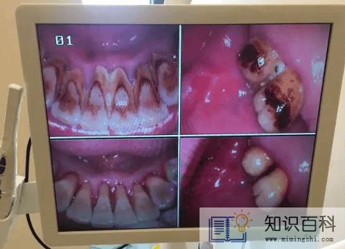 牙结石0度到3度的图2