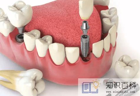牙结石脱落洞会恢复吗3